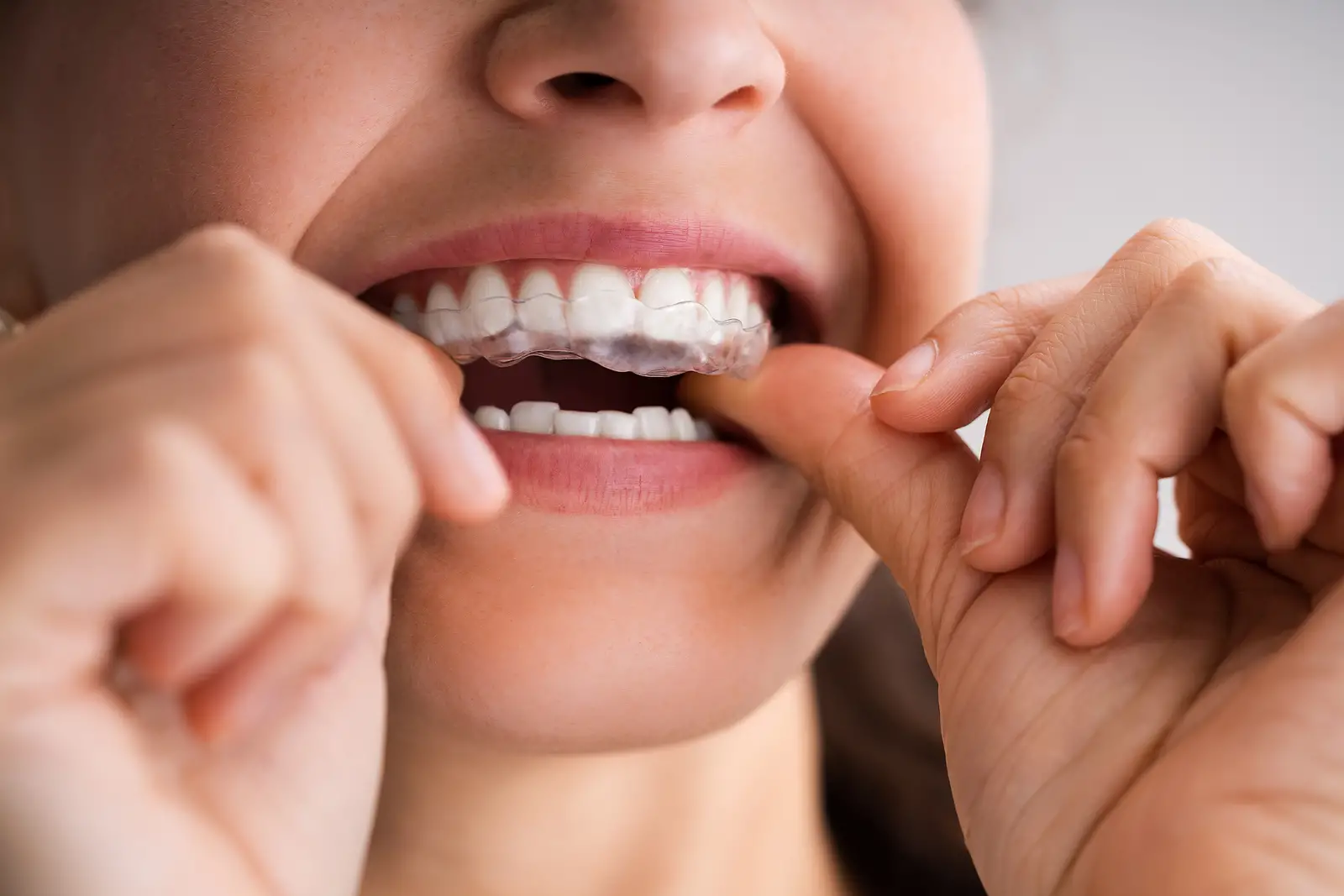 Invisible Solutions: Common Dental Problems That Invisalign Can Fix Without Braces